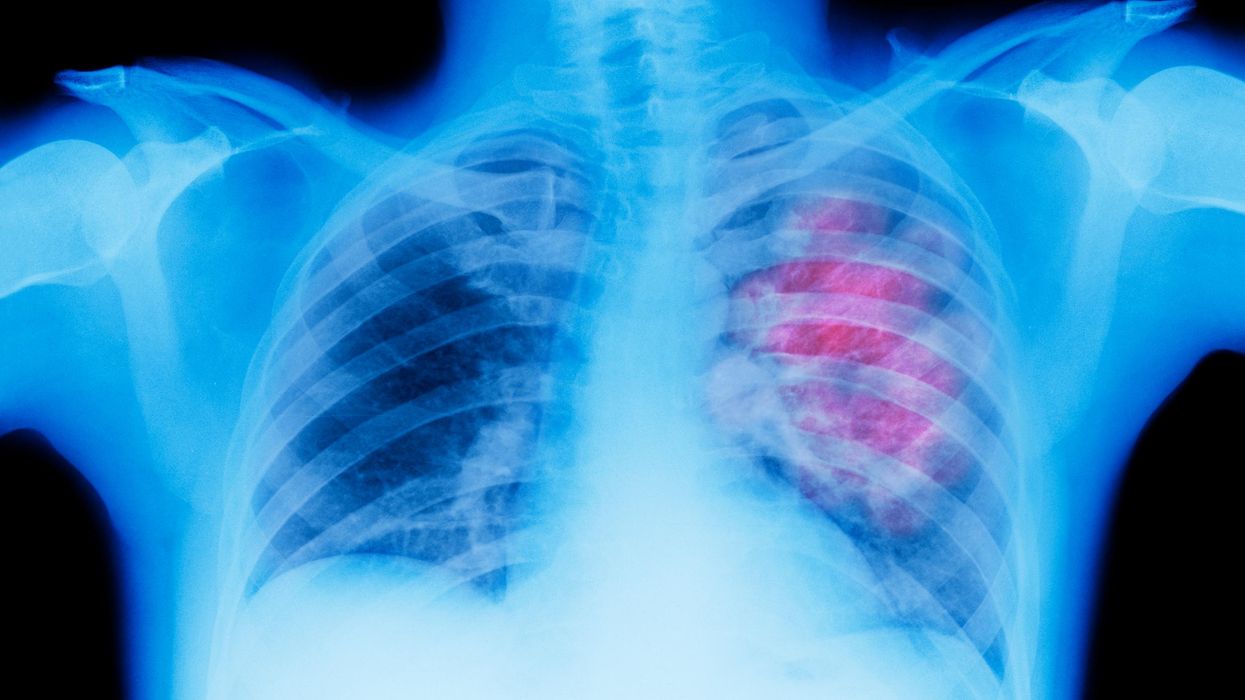US Lung Cancer Survival Rate Rises 21 Percent